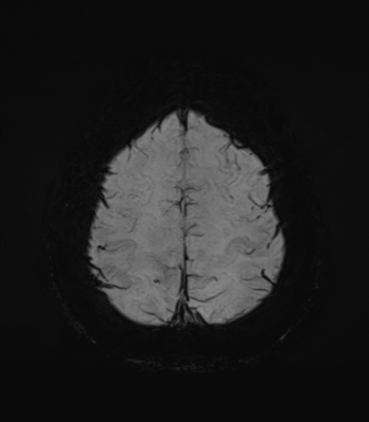 Normal MRI internal auditory canal (Radiopaedia 41613-44525 Axial SWI MIP 68).png