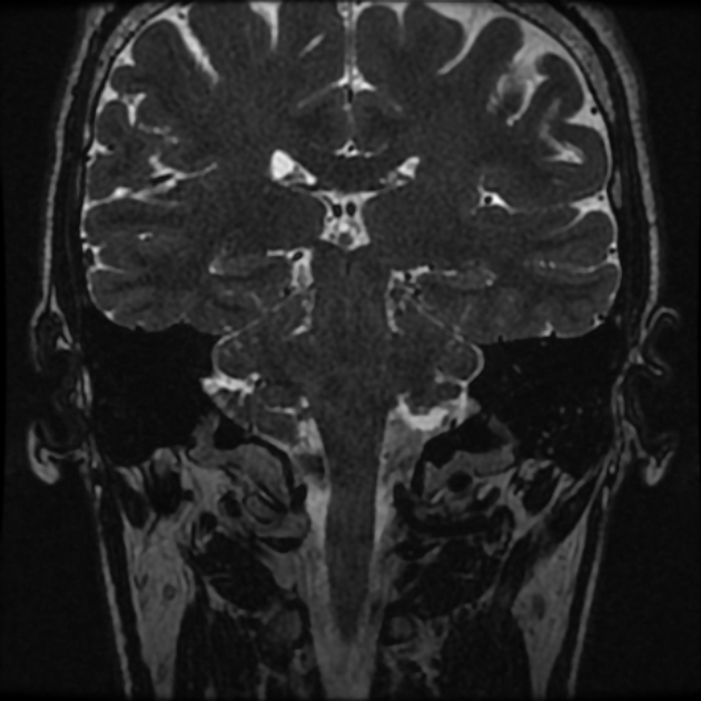 Normal MRI petrous (Radiopaedia 91317-108949 Coronal T2 69).jpg