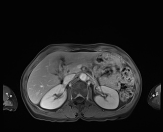 Normal adrenal glands MRI (Radiopaedia 82017-96004 M 34).jpg
