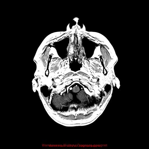 Normal adult brain MRI (non-enhanced and contrast-enhanced) (Radiopaedia 75262-86379 Axial T1 C+ 44).jpg
