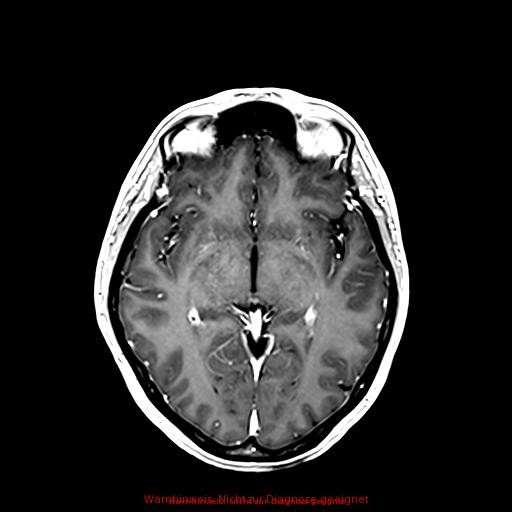 Normal adult brain MRI (non-enhanced and contrast-enhanced) (Radiopaedia 75262-86379 Axial T1 C+ 99).jpg