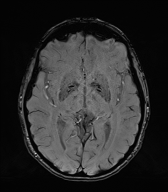Normal brain MRI (TLE protocol) (Radiopaedia 40748-43405 Axial SWI 42).png