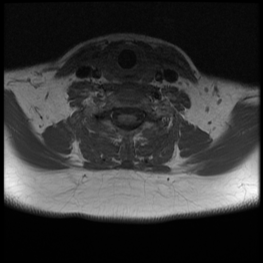 File:Normal cervical and thoracic spine MRI (Radiopaedia 35630-37156 Axial T1 12).png
