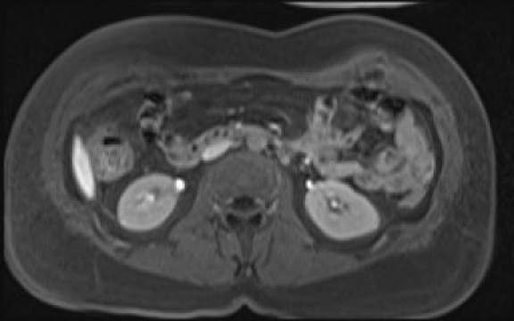File:Normal hepatobiliary phase liver MRI (Radiopaedia 58968-66230 A 70).jpg