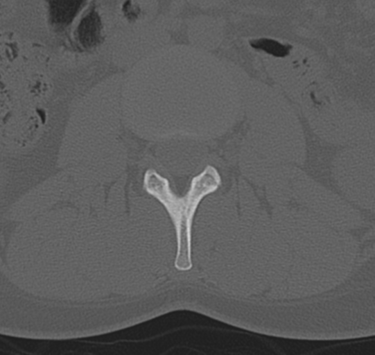 File:Normal lumbar spine CT (Radiopaedia 46533-50986 Axial bone window 29).png