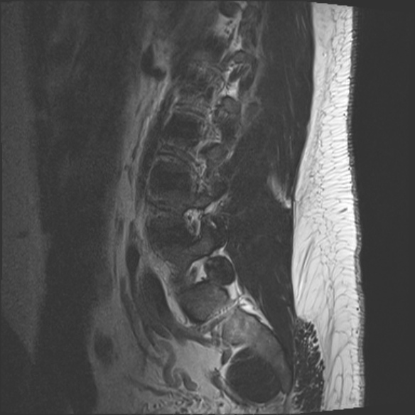 File:Normal lumbar spine MRI (Radiopaedia 47857-52609 Sagittal T2 17).jpg