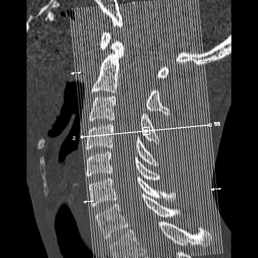 File:Normal trauma cervical spine (Radiopaedia 41017-43760 Coronal bone window 1).png