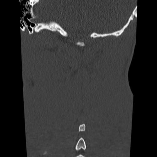File:Normal trauma cervical spine (Radiopaedia 41017-43760 Coronal bone window 40).png