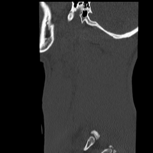 File:Normal trauma cervical spine (Radiopaedia 41017-43760 Sagittal bone window 49).png