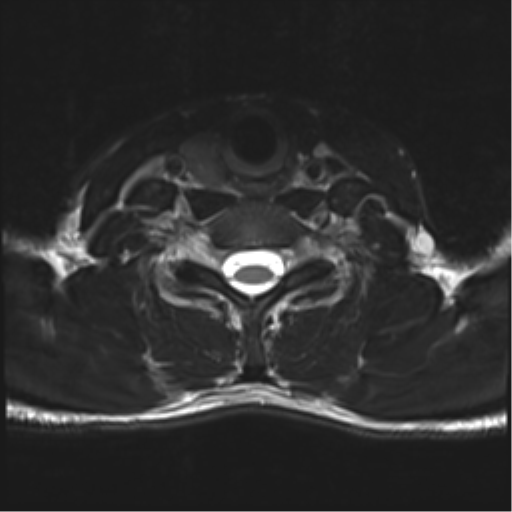 Normal trauma cervical spine (Radiopaedia 41017-43762 D 44).png