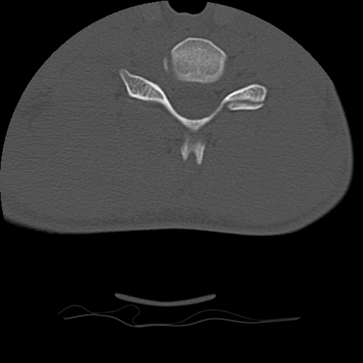 Normal trauma spine imaging (age 16) (Radiopaedia 45335-49358 Axial bone window 58).jpg