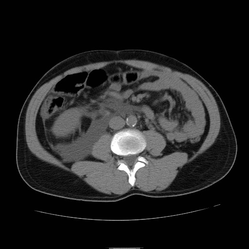File:Obstructed kidney with perinephric urinoma (Radiopaedia 26889-27066 Axial non-contrast 32).jpg