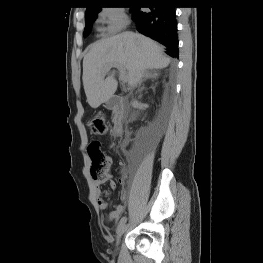 File:Obstructed kidney with perinephric urinoma (Radiopaedia 26889-27066 B 17).jpg