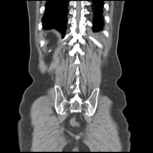 Obstructing renal calculus (Radiopaedia 29517-30016 Coronal non-contrast 45).jpg