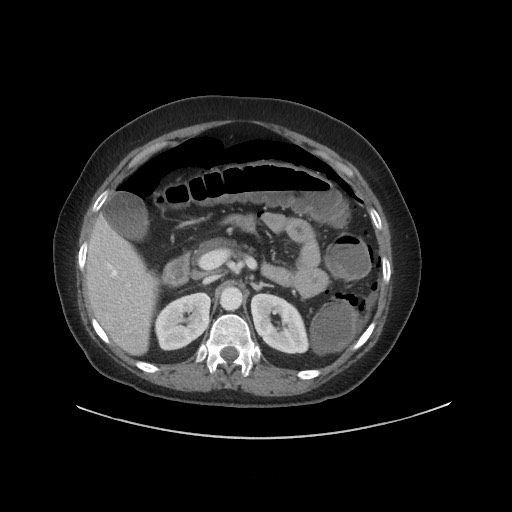 Obstructive distal colonic adenocarcinoma causing cecal perforation (Radiopaedia 86830-102989 A 66).jpg
