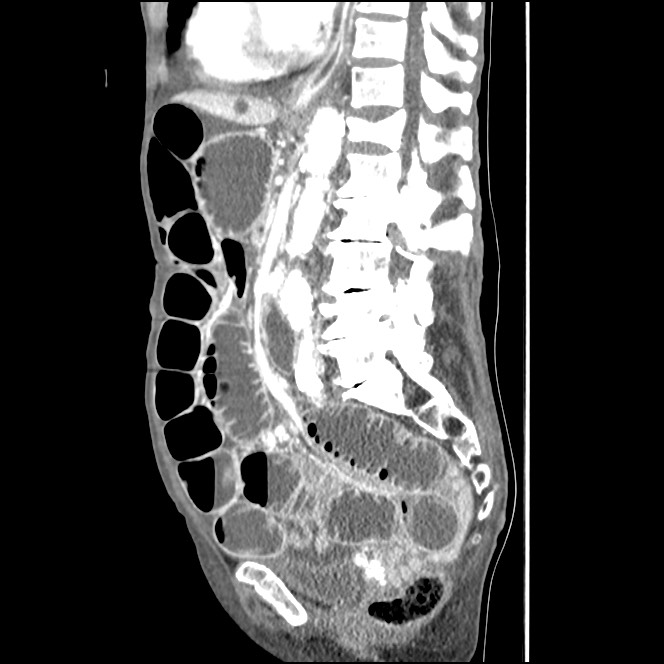 Obturator hernia causing small bowel obstruction (Radiopaedia 65522-74612 C 50).jpg