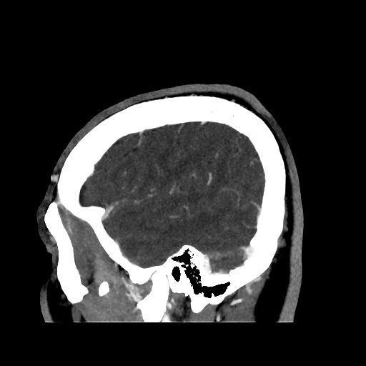 Occipital extradural hematoma simulating venous sinus thrombosis (Radiopaedia 46514-50964 D 14).jpg