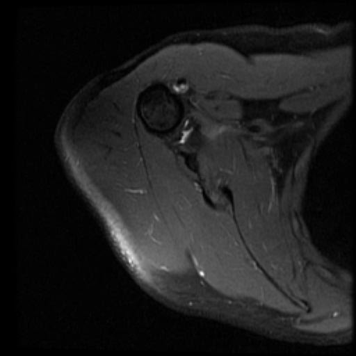 File:ALPSA, SLAP2 tear, and GAGL lesion of shoulder (Radiopaedia 34195-35451 Axial T2 fat sat 12).jpg