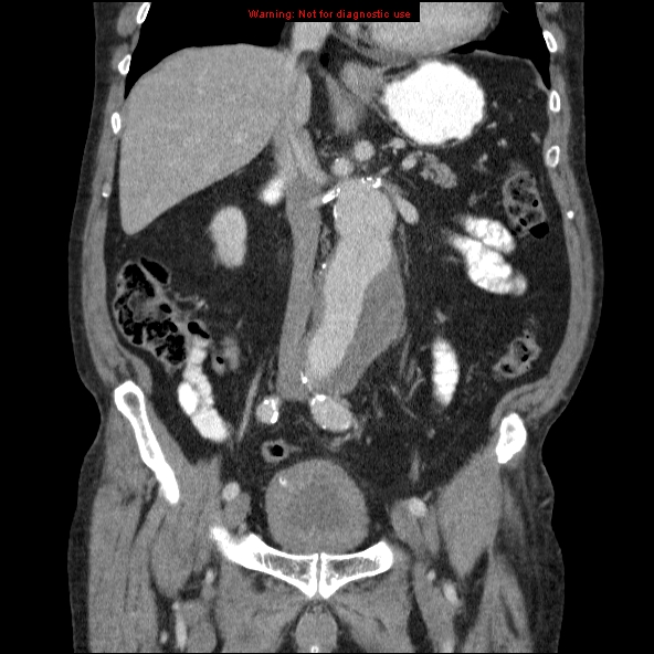 File:Abdominal aortic aneurysm (Radiopaedia 10122-10660 Coronal C+ portal venous phase 21).jpg