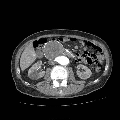 Abdominal aortic aneurysm (Radiopaedia 13341-13340 Axial C+ arterial phase 89).jpg
