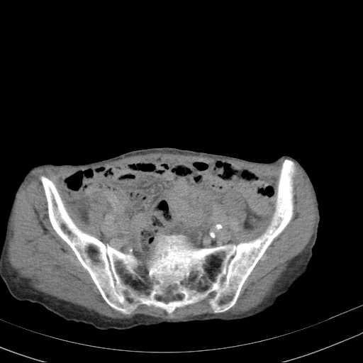 File:Abdominal aortic aneurysm (Radiopaedia 20827-20742 Axial C+ delayed 27).jpg