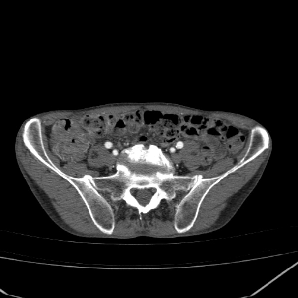 Abdominal aortic aneurysm (Radiopaedia 23703-23856 Axial C+ arterial phase 72).jpg