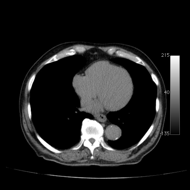 Abdominal aortic aneurysm (Radiopaedia 29248-29660 Axial non-contrast 3).jpg