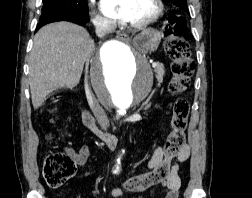 File:Abdominal aortic aneurysm (Radiopaedia 67117-76452 Coronal C+ arterial phase 42).jpg