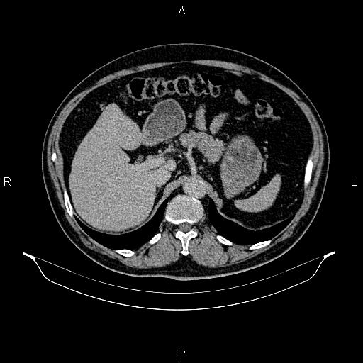 Abdominal aortic aneurysm (Radiopaedia 83094-97462 Axial renal excretory phase 33).jpg