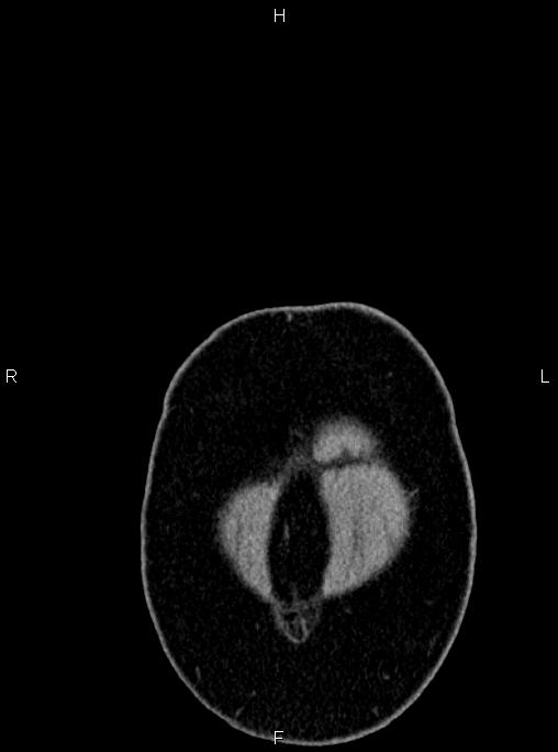 Abdominal aortic aneurysm (Radiopaedia 83094-97462 Coronal renal cortical phase 1).jpg