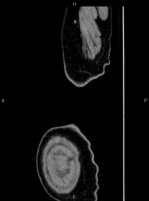 Abdominal aortic aneurysm (Radiopaedia 83094-97462 Sagittal renal cortical phase 127).jpg