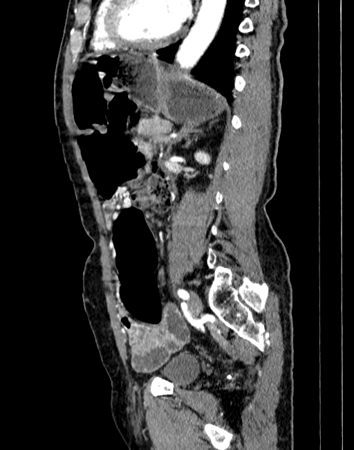 Abdominal aortic aneurysm (Radiopaedia 83581-98689 Sagittal C+ arterial phase 71).jpg