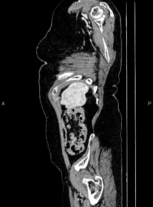 Abdominal aortic aneurysm (Radiopaedia 85063-100606 Sagittal C+ arterial phase 74).jpg