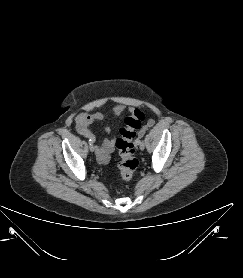 Abdominal aortic aneurysm with thrombus fissuration (Radiopaedia 46218-50618 Axial non-contrast 49).jpg