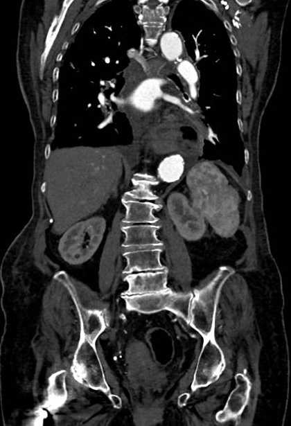 Abdominal aortic aneurysm with thrombus fissuration (Radiopaedia 73192-83919 Coronal C+ arterial phase 56).jpg