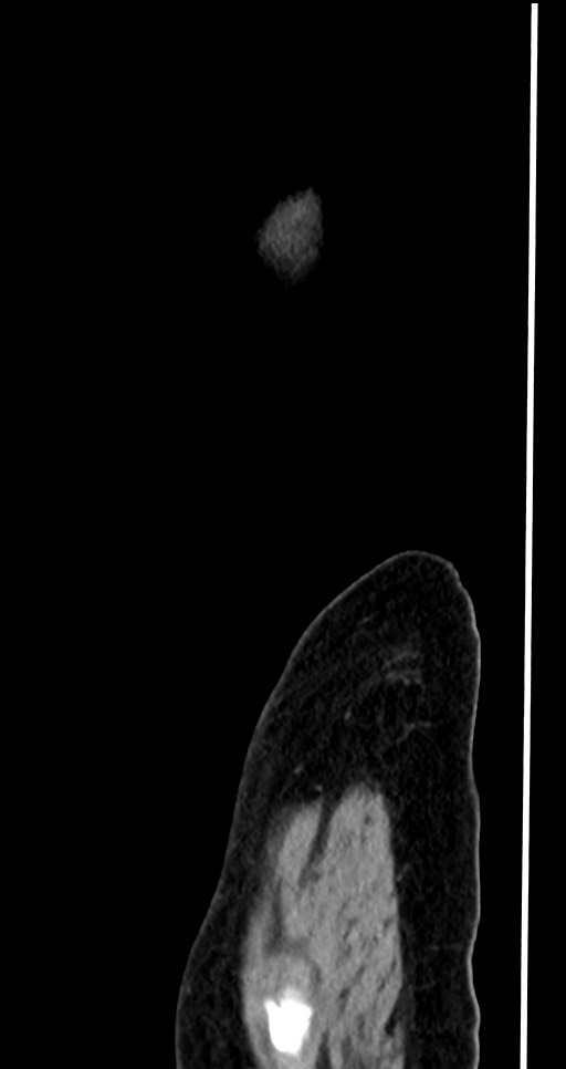 Abdominal wall and retroperitoneal tuberculosis (Radiopaedia 88137-104729 Sagittal C+ portal venous phase 9).jpg