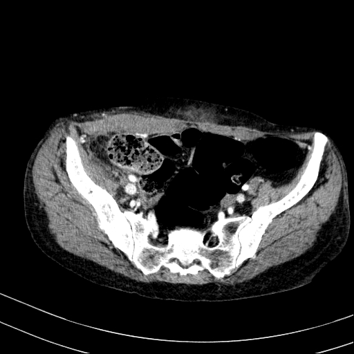 Abdominal wall hematoma with active bleeding (Radiopaedia 83915-99117 Axial renal cortical phase 107).jpg