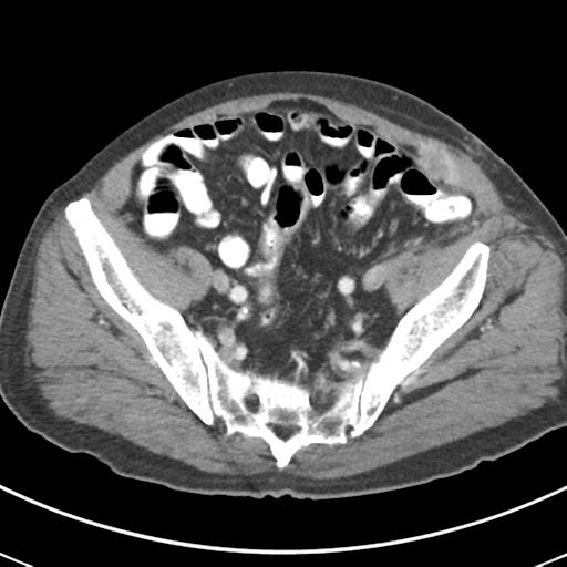 Abdominal wall metastasis from colorectal carcinoma (Radiopaedia 31016-31717 Axial C+ portal venous phase 61).jpg