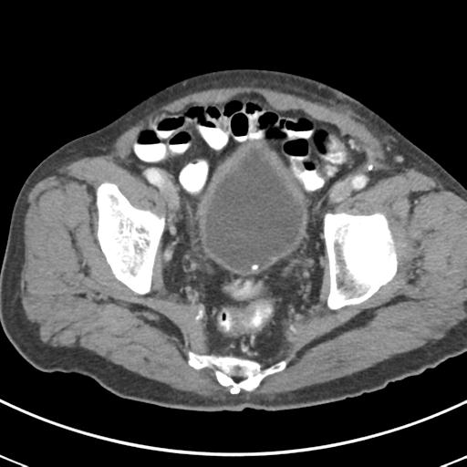 Abdominal wall metastasis from colorectal carcinoma (Radiopaedia 31016-31717 Axial C+ portal venous phase 67).jpg