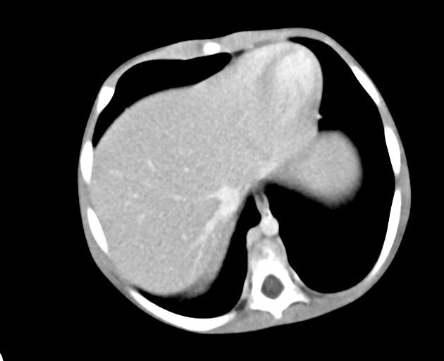 Abdominopelvic rhabdomyosarcoma (Radiopaedia 78356-90984 Axial C+ portal venous phase 38).jpg