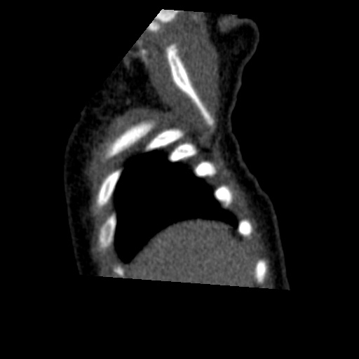 Aberrant left pulmonary artery (pulmonary sling) (Radiopaedia 42323-45435 Sagittal C+ arterial phase 4).jpg