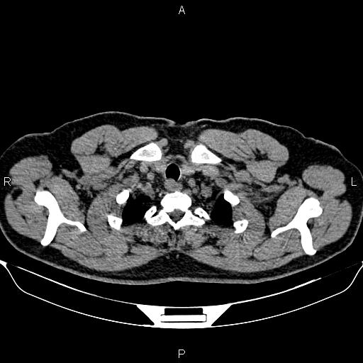 Aberrant right subclavian artery (Radiopaedia 87093-103354 Axial non-contrast 9).jpg