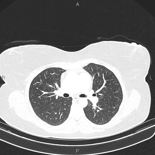 File:Aberrant right subclavian artery (Radiopaedia 87334-103629 Axial lung window 30).jpg