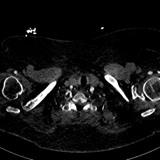 Aberrant right subclavian artery with Kommerell diverticulum (Radiopaedia 47982-52769 Axial C+ arterial phase 3).png