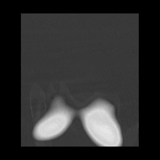Accessory left horizontal fissure with lingular pneumonia (Radiopaedia 53763-59843 Coronal lung window 1).jpg