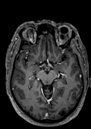 Accessory middle cerebral artery (Radiopaedia 73114-83828 Axial T1 C+ 64).jpg