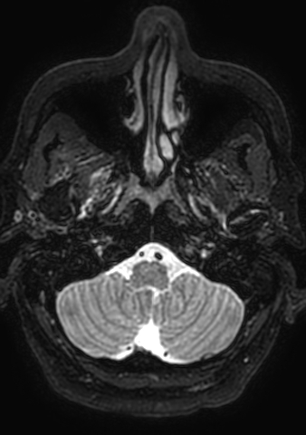 Accessory middle cerebral artery (Radiopaedia 73114-83828 Axial T2 198).jpg