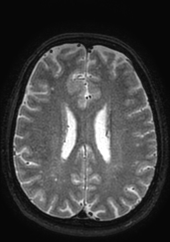 Accessory middle cerebral artery (Radiopaedia 73114-83828 Axial T2 20).jpg