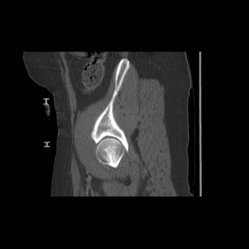File:Acetabular fracture (Radiopaedia 13193-13212 Sagittal bone window 19).jpg