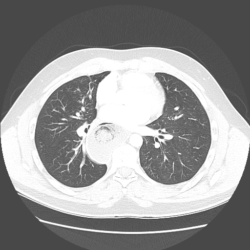 File:Achalasia (Radiopaedia 52507-58417 Axial lung window 35).jpg